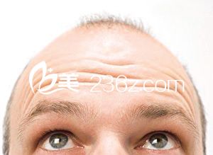 沈陽無痕植發(fā)一次大概要多少錢？