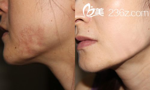 燒燙傷疤痕修復(fù)手術(shù)前后對(duì)比