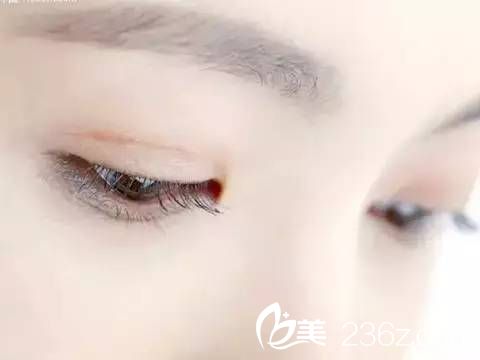 詳解全切雙眼皮全過程