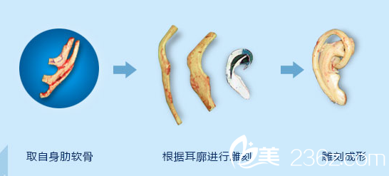 先天小耳畸形的再造時機選擇及治療方式 先天小耳畸形的再造時機選擇及治療方式