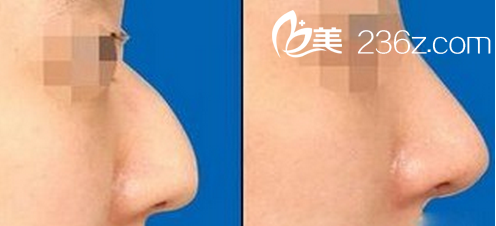 鷹鉤鼻矯正術(shù)