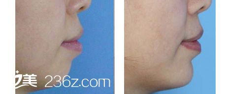 自體脂肪填充下巴