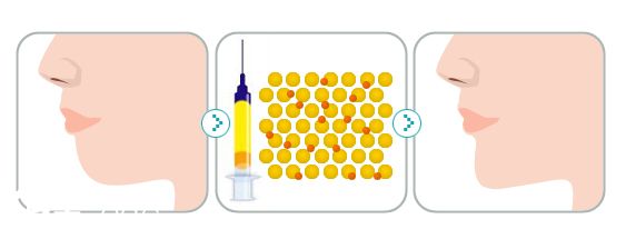自體脂肪填充下巴