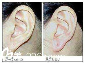 注射玻尿酸豐耳垂