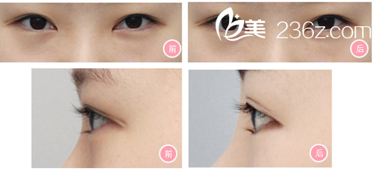 韓式無痕開眼角