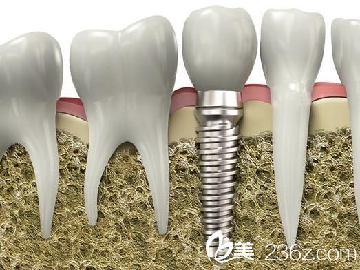 快速醫(yī)療種植牙