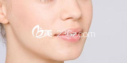 鼻唇溝紋怎么去除