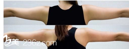 手臂抽脂多少錢