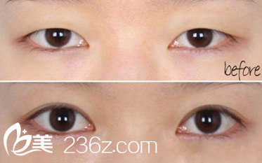 內雙割雙眼皮
