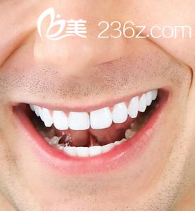 美白牙齒的方法