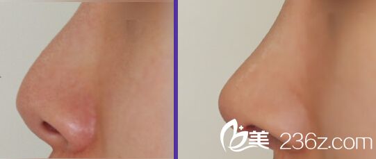 鼻子整形失敗，二次隆鼻后效果