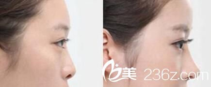 二次隆鼻整形對(duì)比案例