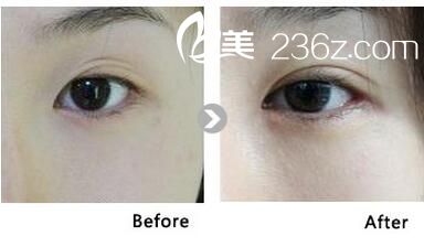 雙眼皮修復(fù)