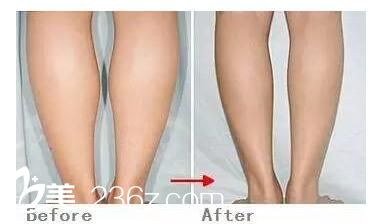 瘦腿效果對(duì)比圖