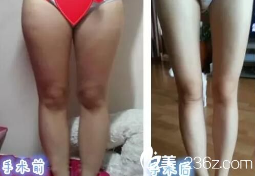 吸脂瘦腿對(duì)比效果圖