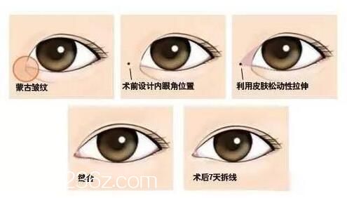 <!--<i data=20240703-sp></i>-->整形5S重瞼雙眼皮術(shù)，眼角調(diào)整放大雙眼