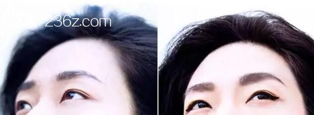 內(nèi)雙也需要做雙眼皮手術(shù)