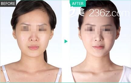 自體脂肪填充案例