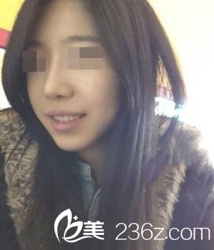 　　　　先來一張術(shù)前的照片哈　　　　從側(cè)面看是不是好像木有鼻